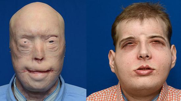أكبر عملية لزراعة الوجه.. متبرع يهب وجهه لرجل إطفاء