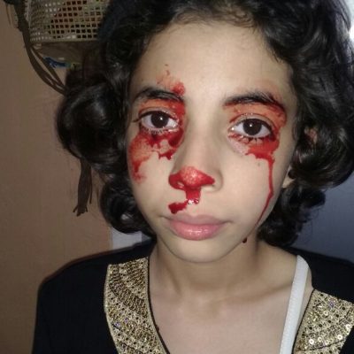 مأساة الطفلة آية.. كتبكي الدم!! (صور)