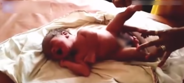 بالفيديو من الهند.. طفل بأربعة أرجل وعضوين تناسليين