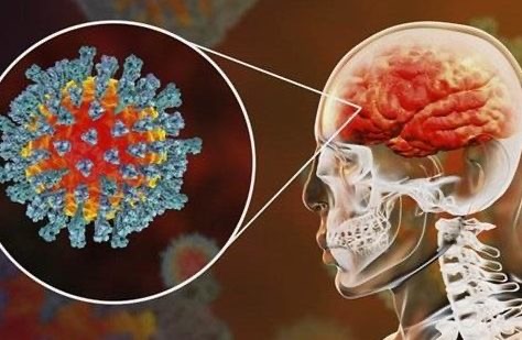 وجود تلف في الأوعية الدموية.. دراسة تكشف تأثير فيروس كورونا على الدماغ