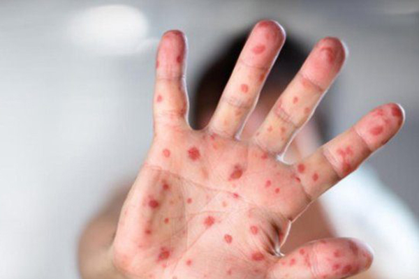 بعد رصدها حالات جديدة من “بوحمرون”.. وزارة الصحة تعلن حملة استدراكية واسعة لتعزيز اللقاح